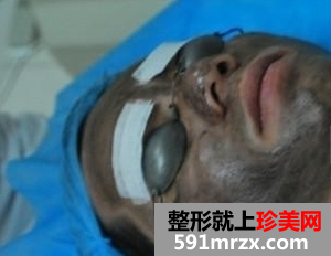 黑脸娃娃美白前后效果对比图和恢复过程