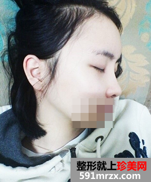 黑脸娃娃美白前后效果对比图和恢复过程