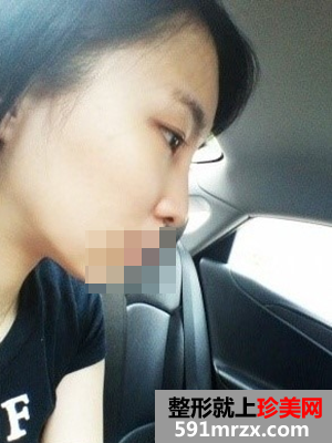 黑脸娃娃美白前后效果对比图和恢复过程