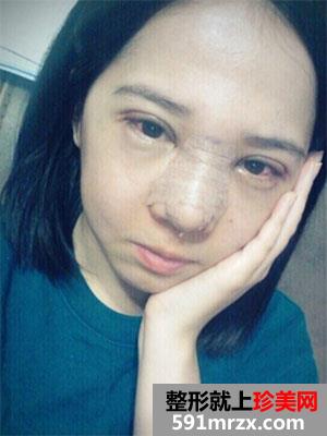 硅胶假体隆鼻术+压线双眼皮真实案例图分享和恢复过程