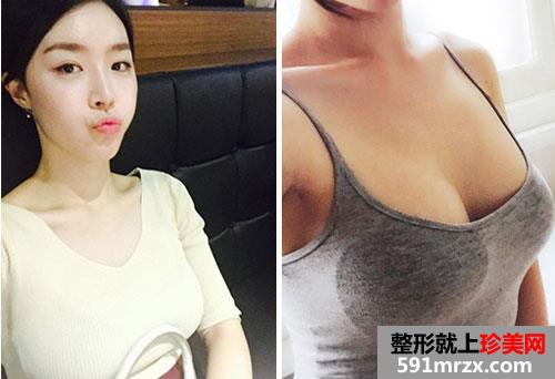 曼托水滴形假体隆胸术前后效果对比照和恢复过程分享