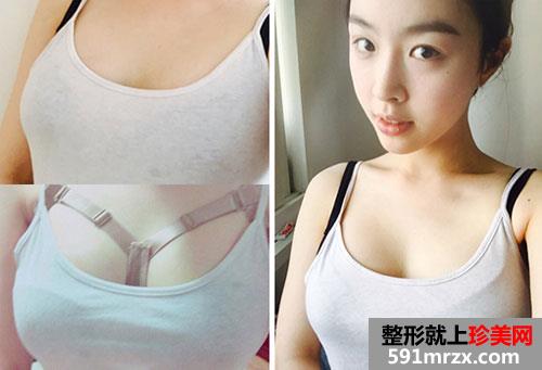 曼托水滴形假体隆胸术前后效果对比照和恢复过程分享