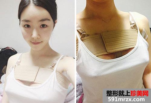曼托水滴形假体隆胸术前后效果对比照和恢复过程分享
