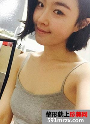 曼托水滴形假体隆胸术前后效果对比照和恢复过程分享
