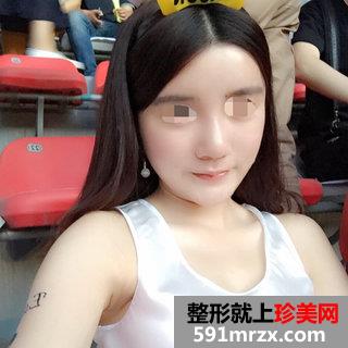 自体脂肪面部填充后四个月效果图分享