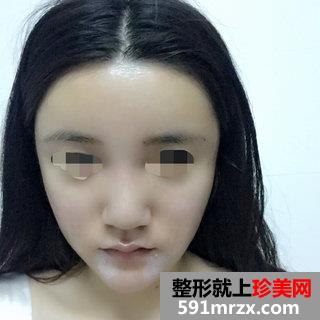 自体脂肪面部填充后四个月效果图分享