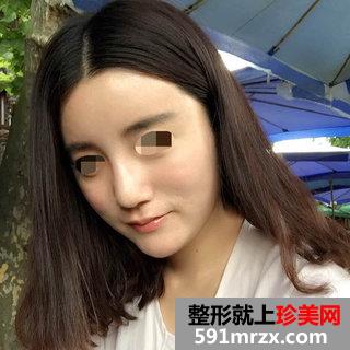 自体脂肪面部填充后四个月效果图分享