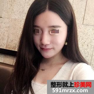 自体脂肪面部填充后四个月效果图分享