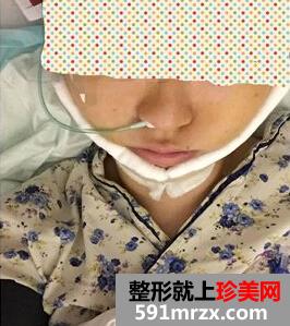 为了更瘦一些做了面部吸脂+大腿吸脂