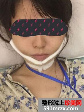 为了更瘦一些做了面部吸脂+大腿吸脂