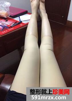 为了更瘦一些做了面部吸脂+大腿吸脂
