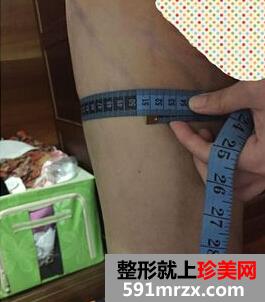 为了更瘦一些做了面部吸脂+大腿吸脂