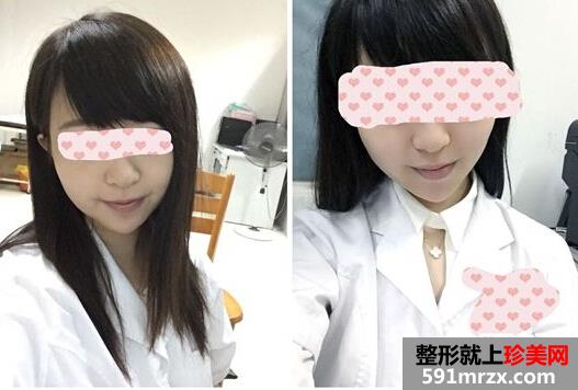 为了更瘦一些做了面部吸脂+大腿吸脂