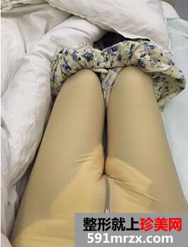为了更瘦一些做了面部吸脂+大腿吸脂