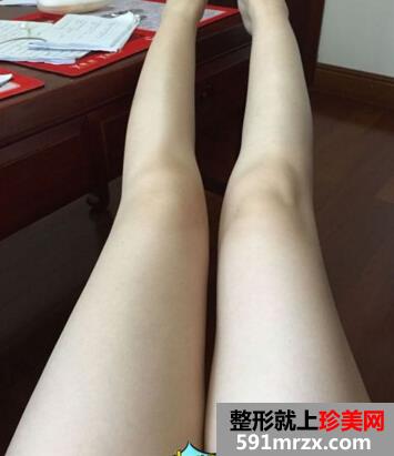 为了更瘦一些做了面部吸脂+大腿吸脂