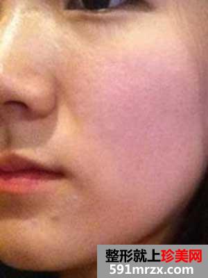 人造酒窝,手术,恢复,过程,前后,效果,对比,图片,案例,分享