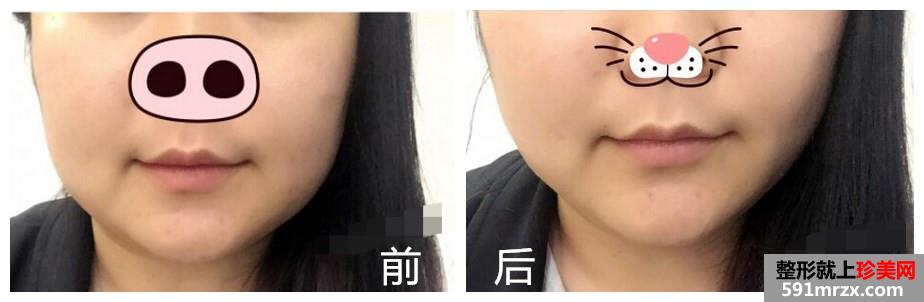 第一次打瘦脸针 效果还是挺满意的