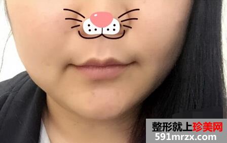 第一次打瘦脸针 效果还是挺满意的