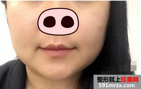 第一次打瘦脸针 效果还是挺满意的