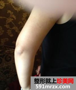 胸部下垂,自体脂肪隆胸