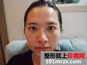 自体脂肪移植丰面颊手术恢复过程及前后对比效果图