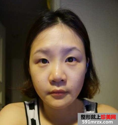 欧式,双眼皮,达拉斯,隆鼻,手术,恢复,过程,前后,对比,效果图