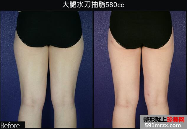 腿部吸脂手术多少钱