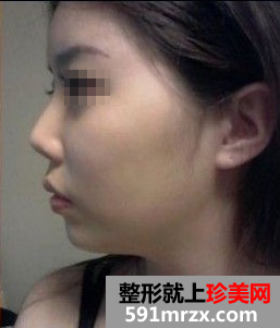 做了膨体+自体耳软骨隆鼻后 大家都说我比女神还女神