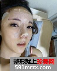 综合隆鼻手术恢复过程 硅胶隆鼻+鼻尖软骨+鼻翼缩小