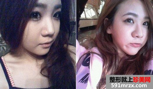 综合隆鼻手术恢复过程 硅胶隆鼻+鼻尖软骨+鼻翼缩小