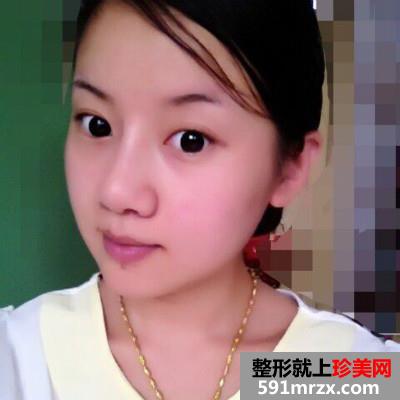 婴儿肥做了面部吸脂后的效果图奉上