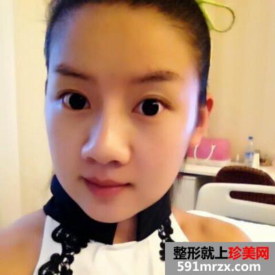 婴儿肥做了面部吸脂后的效果图奉上