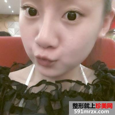 婴儿肥做了面部吸脂后的效果图奉上