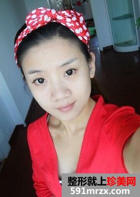 婴儿肥做了面部吸脂后的效果图奉上