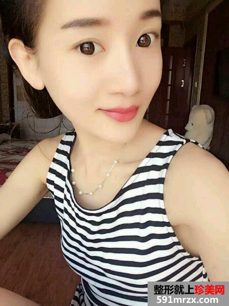 婴儿肥做了面部吸脂后的效果图奉上
