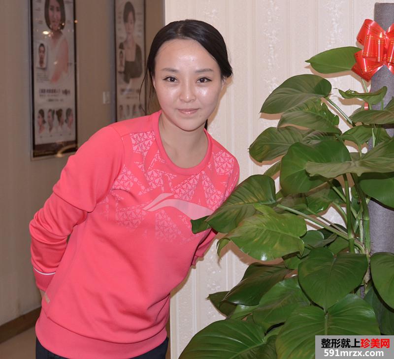 3度仿生美鼻+彩光祛雀斑+多维立体丰下颏前后对比效果图片