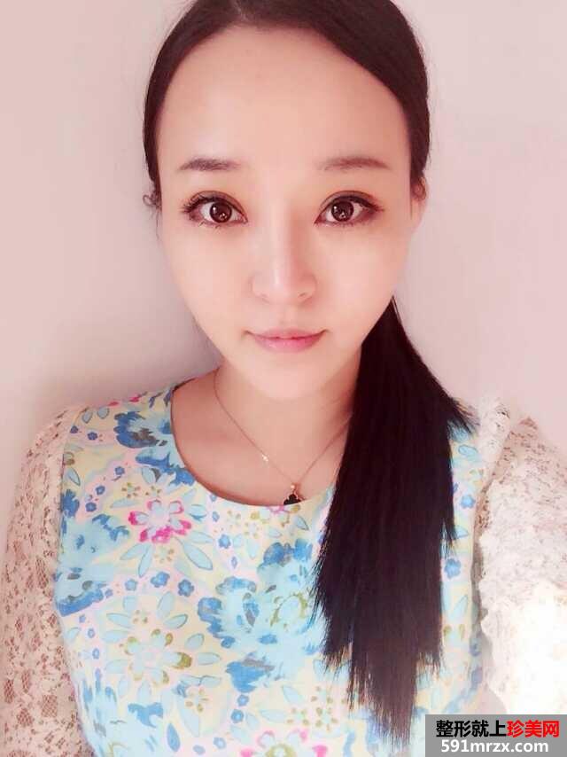 3度仿生美鼻+彩光祛雀斑+多维立体丰下颏前后对比效果图片
