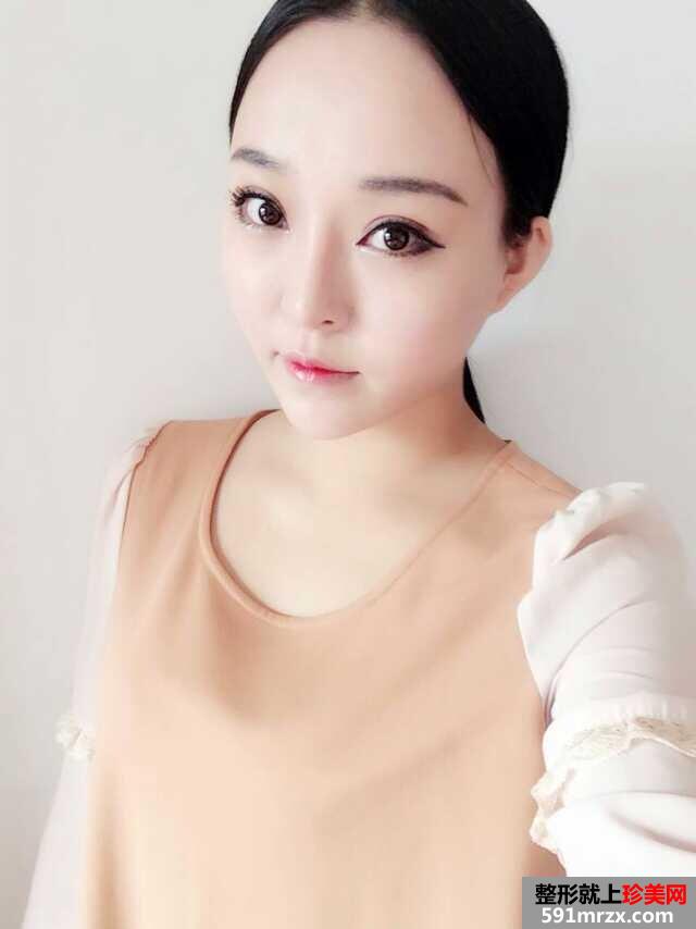 3度仿生美鼻+彩光祛雀斑+多维立体丰下颏前后对比效果图片
