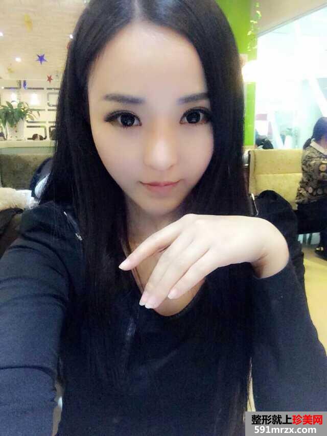 3度仿生美鼻+彩光祛雀斑+多维立体丰下颏前后对比效果图片