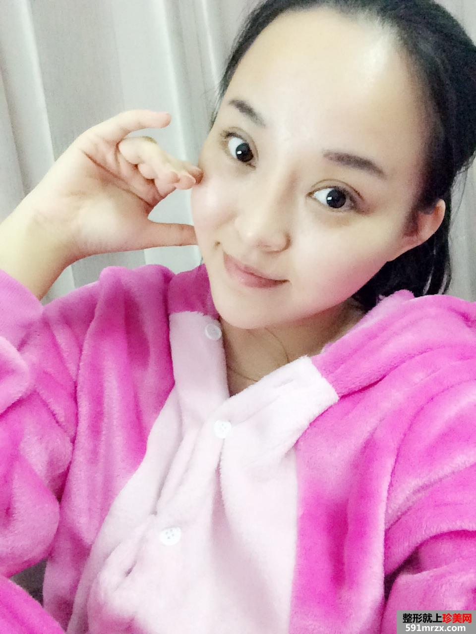 3度仿生美鼻+彩光祛雀斑+多维立体丰下颏前后对比效果图片
