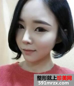 鼻头鼻翼缩小手术,我是一个大美女