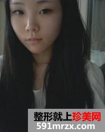 鼻头鼻翼缩小手术,我是一个大美女
