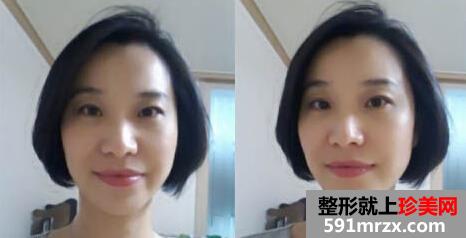 做了2次E光嫩肤 皮肤光滑多了