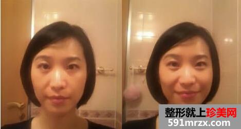 做了2次E光嫩肤 皮肤光滑多了
