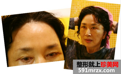 热玛吉,面部,除皱,美容,恢复,过程,前后,对比,效果,图片