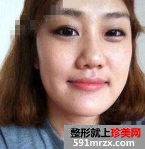 下颌角整形案例分享 同学都说我像张馨予