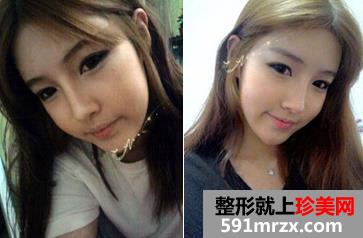 自体脂肪面部填充+鼻综合术后恢复效果对比