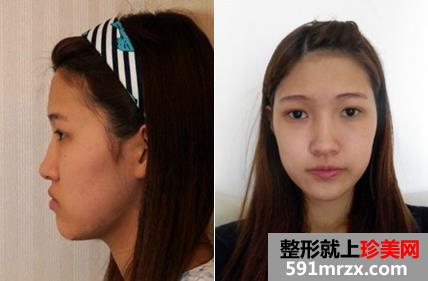 自体脂肪面部填充+鼻综合术后恢复效果对比