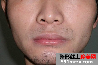 激光脱胡子 轻松甩掉大叔形象