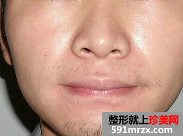 激光脱胡子 轻松甩掉大叔形象